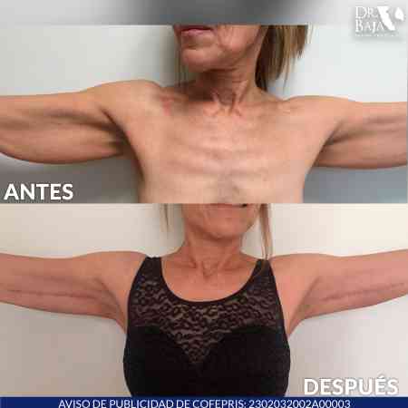 Braquioplastia-3