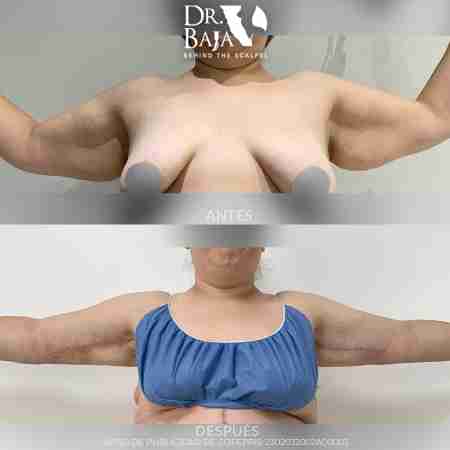 Braquioplastia-4