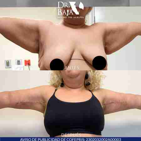Braquioplastia-5