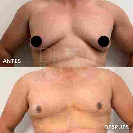 Ginecomastia-9