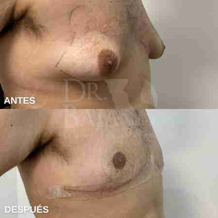 Gynecomastia-8