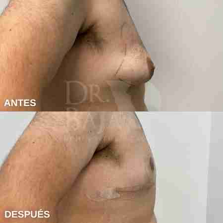 Gynecomastia-9