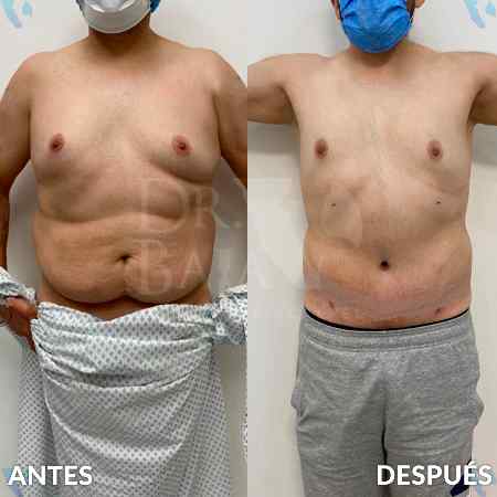 Tummy Tuck-4