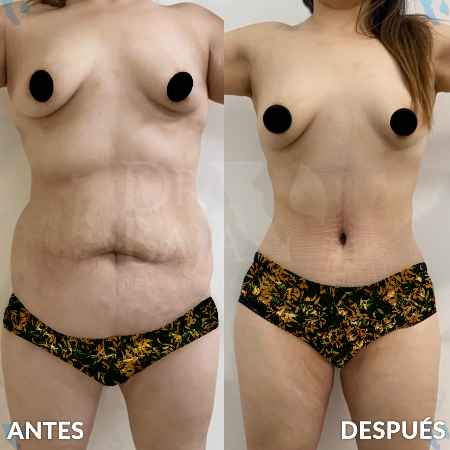 Tummy Tuck-7
