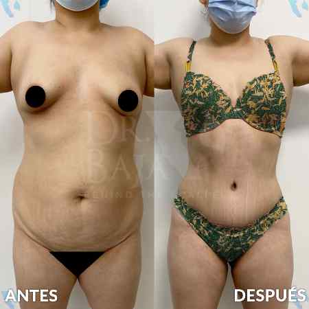 Lipectomía-12