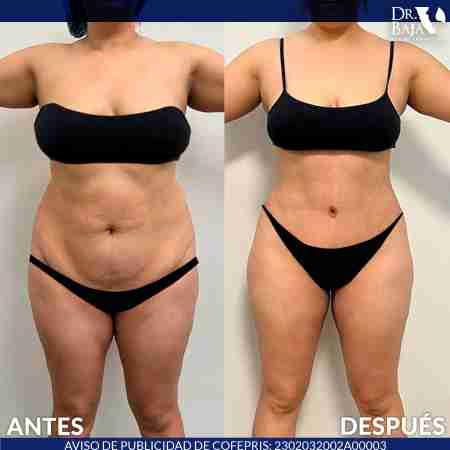 Tummy Tuck-16