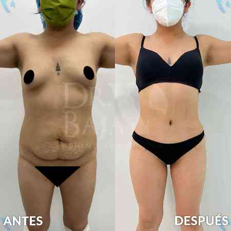 Tummy Tuck-24