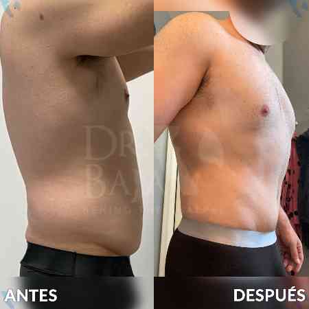 Tummy Tuck-27