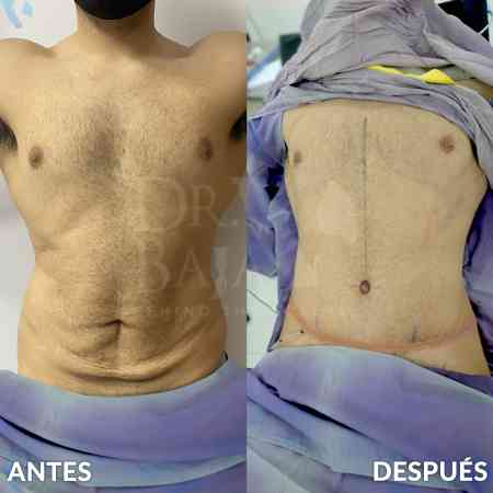 Tummy Tuck-29