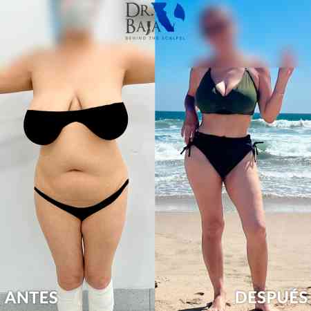 Tummy Tuck-29