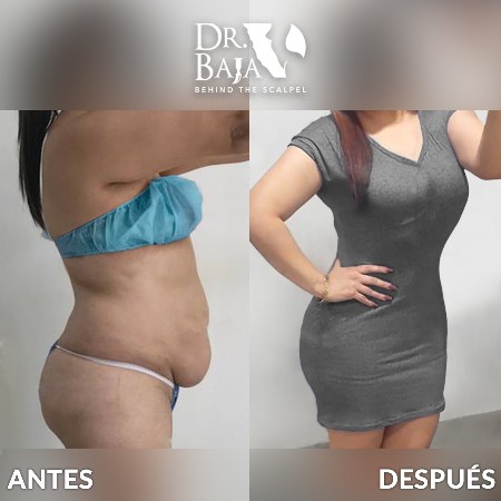 Tummy Tuck-35