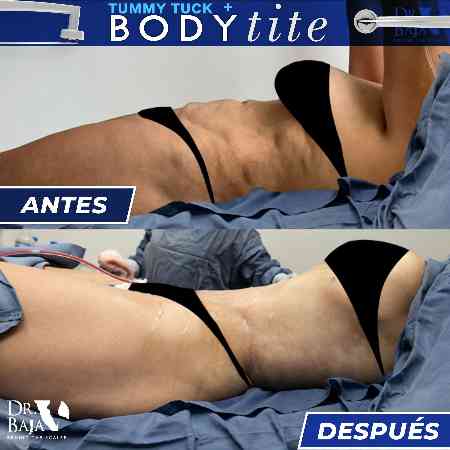 Tummy Tuck-33