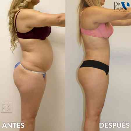 Lipectomía-39