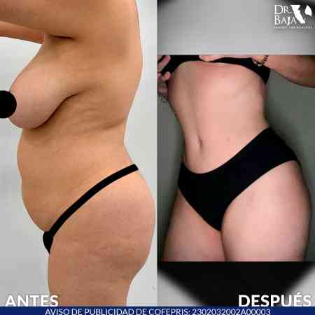 Tummy Tuck-46