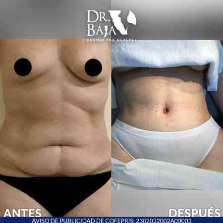 Tummy Tuck-48