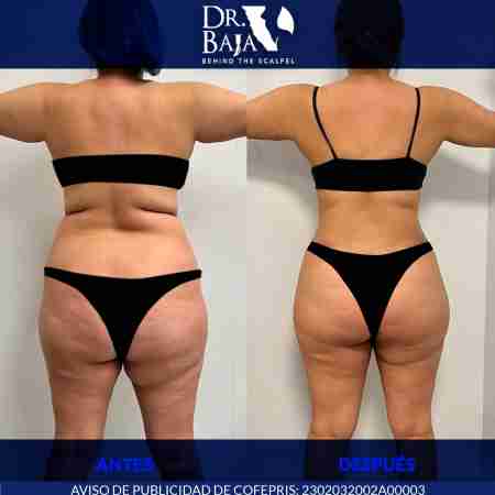 Lipectomía-55