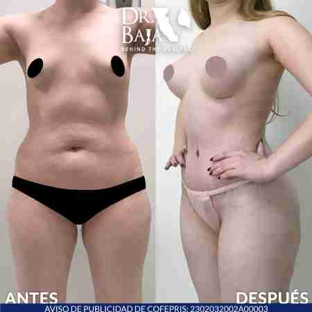 Tummy Tuck-57