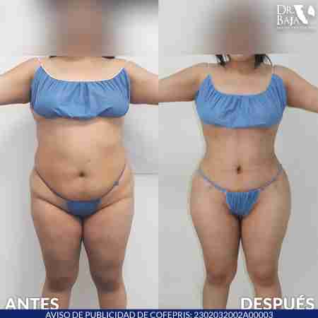 Tummy Tuck-59