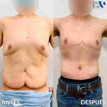 Tummy Tuck-66