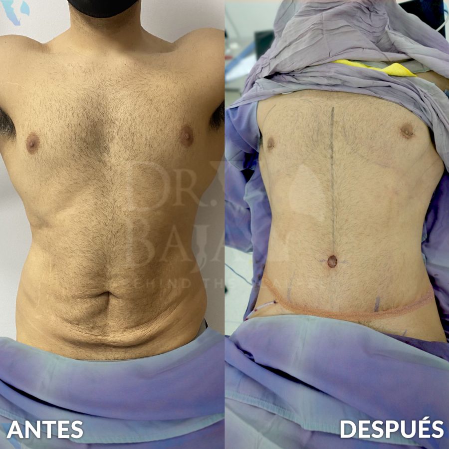 Tummy Tuck for Men Dr. Baja