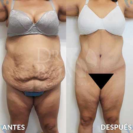 Tummy Tuck-1