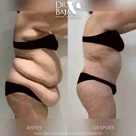 Tummy Tuck-3