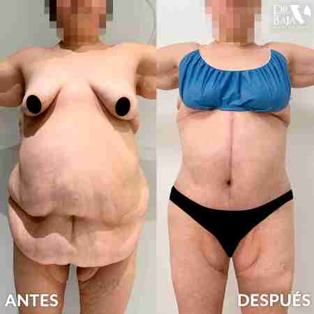 Tummy Tuck-4