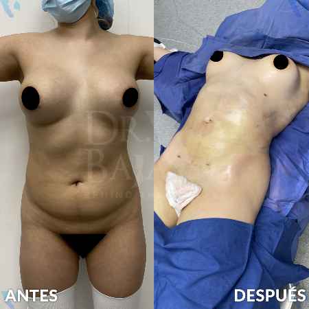 Liposculpture HD-9