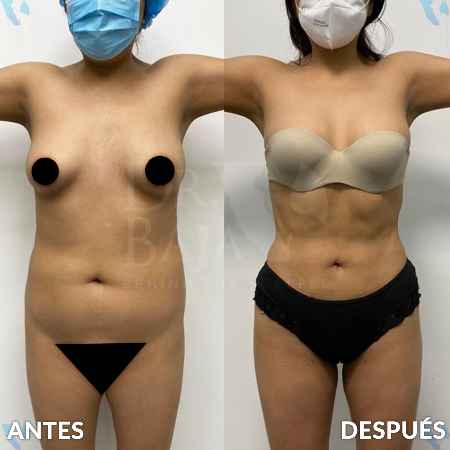 Lipoescultura HD-12