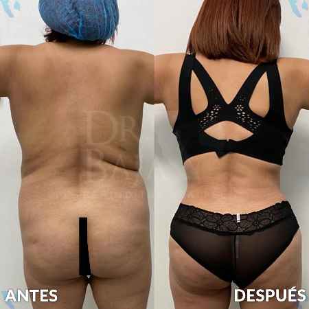 Lipoescultura HD-13