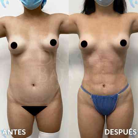 Liposculpture HD-14