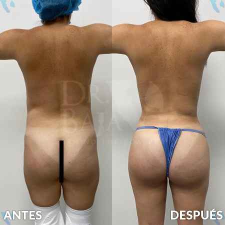 Liposculpture HD-16