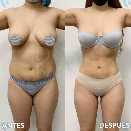 Liposculpture HD-24