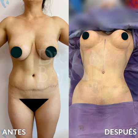 Liposculpture HD-25