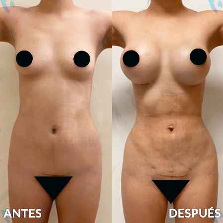 Liposculpture HD-26