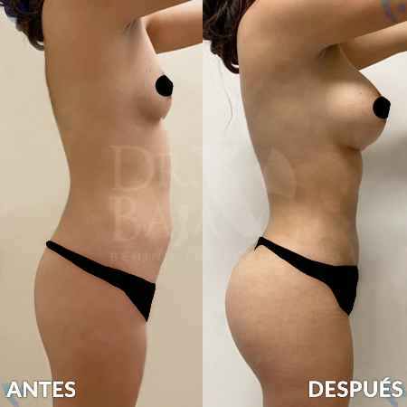 Liposculpture HD-27