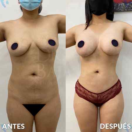 Liposculpture HD-30