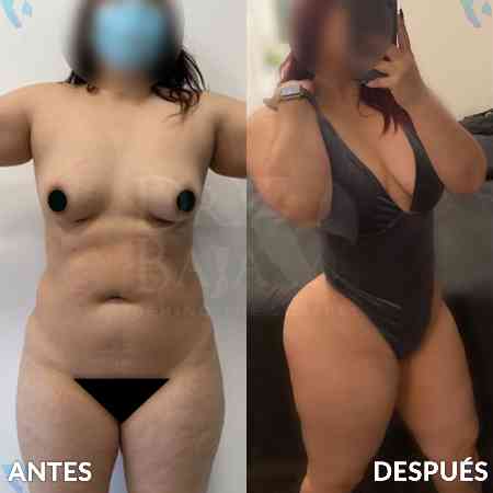 Liposculpture HD-31