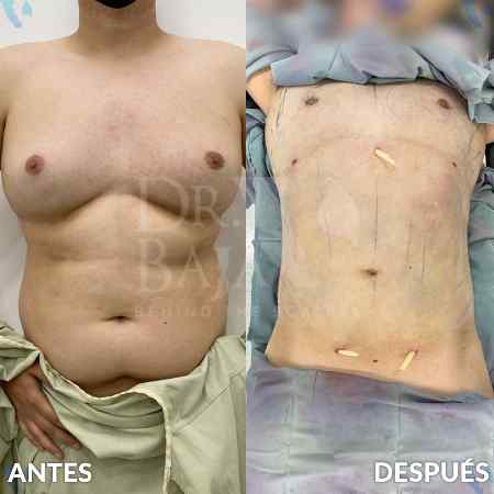 Liposculpture HD-33