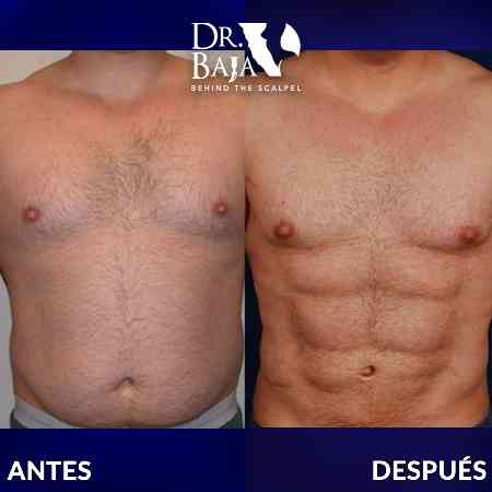 Liposculpture HD-41