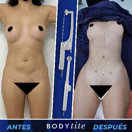 Liposculpture HD-39