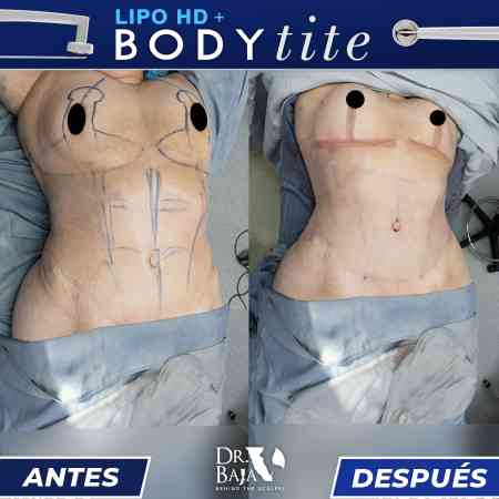 Lipoescultura HD-40