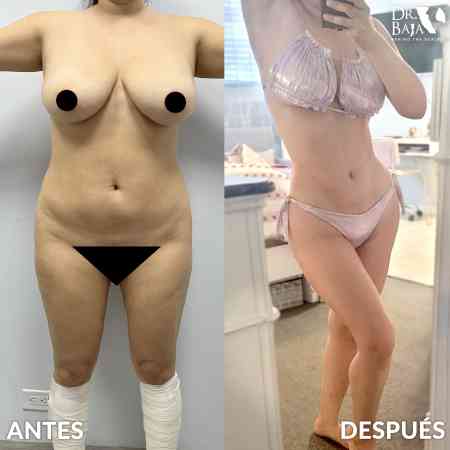 Liposculpture HD-41