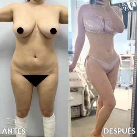 Liposculpture HD-42