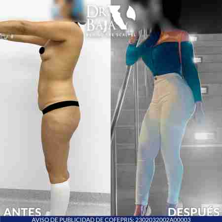 Liposculpture HD-44