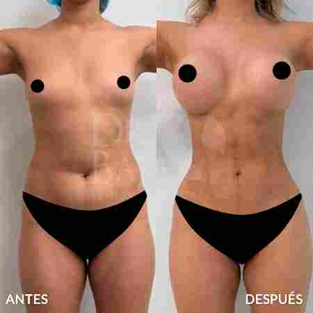 Liposculpture HD-46