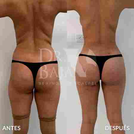 Liposculpture HD-47