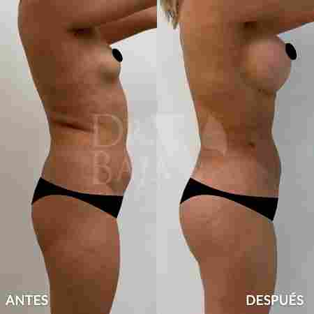 Liposculpture HD-52