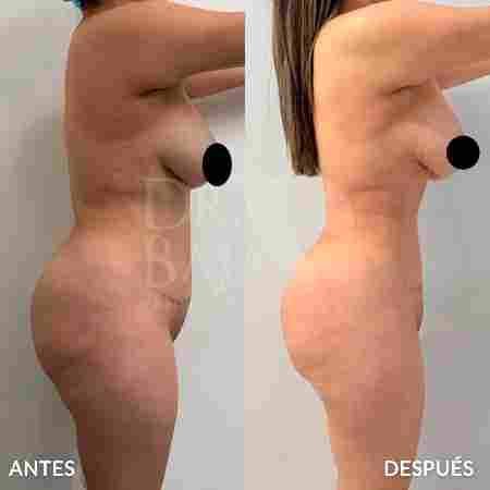 Liposculpture HD-49
