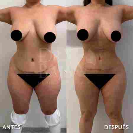 Liposculpture HD-50